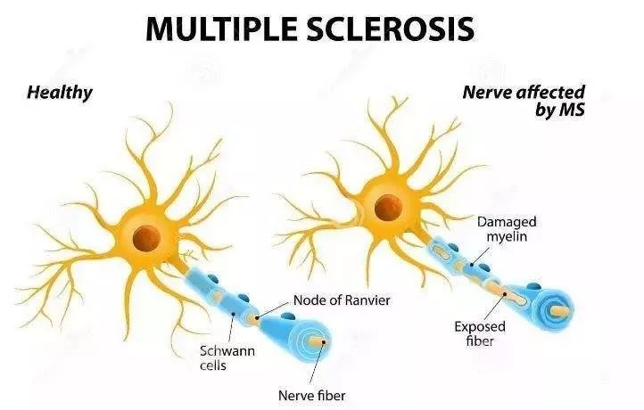 多发性硬化最新疗法探索，希望之光