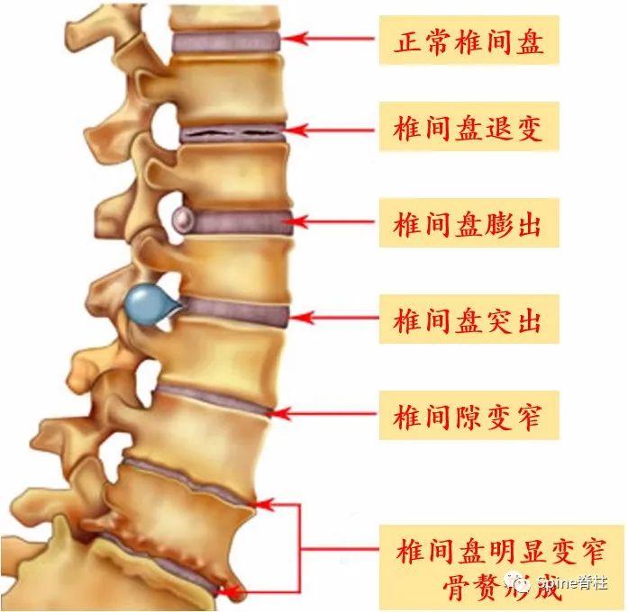 腰间盘突出最新疗法，科技与医学进步的结合力量探索